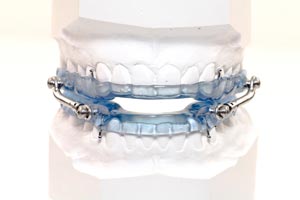 Oral Appliance Therapy